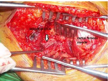 Fig. 3.  View of lateral femoral circumflex artery in fatty tissue over  the vastus intermedius muscle