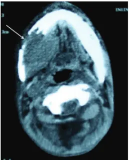 Figure 1: Oral examination showed a mass with nodular tissue causing severe dysphagia and respiratory distress.