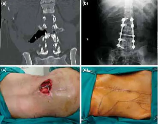 Şekil 1. Olgu 1 (a) lomber omurgada parçalı kırık (BT), (b) stabilisasyon entsturmanı yerleşimi (ön-arka  görünüm), (c) sırtta omurga kemiklerini açığa çıkaran doku defekti, (d) “ekstended” RAM flebin  planlan-ması ve geçirilmiş abdominal cerrahi skarı.