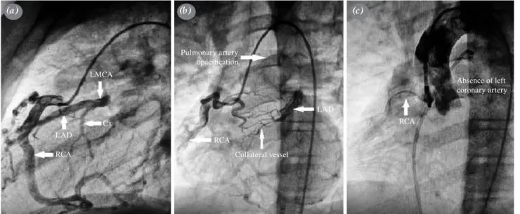 Figure 2. Coronary angiography. (a) Main coronary arteries. (b) Pulmonary artery opacification and prominent collateral vessels