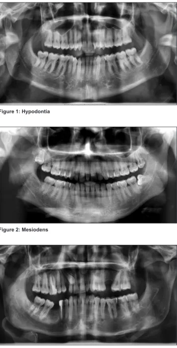 Figure 2: Mesiodens