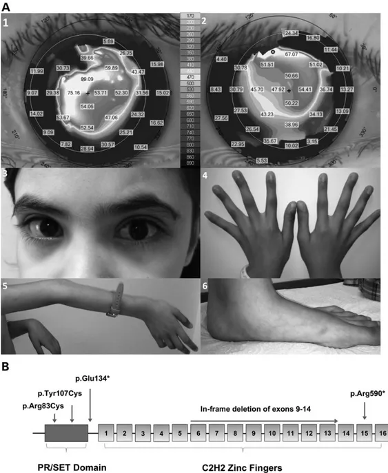 Figure 1. Clinical features of patient P4 and schematic diagram of PRDM5. (A) Clinical features of patient P4 (Table 1), a 9-year whose phenotype includes marked corneal thinning with central corneal thickness measurements of 350 µm left eye and 380 µm rig