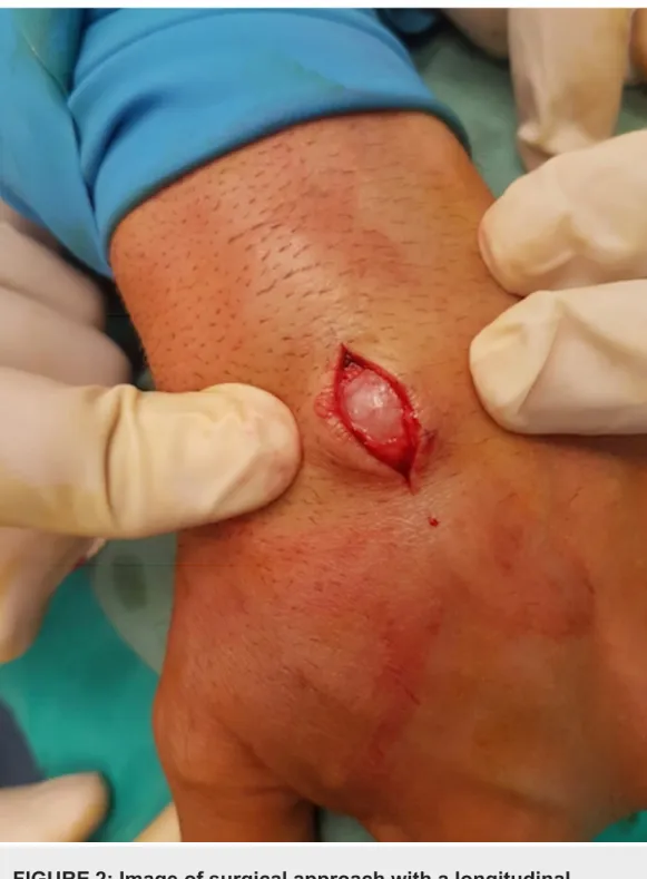FIGURE 2: Image of surgical approach with a longitudinal incision