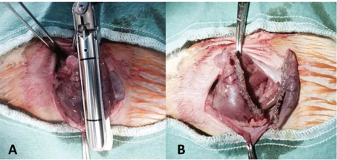 Figure 1 - A. Sleeve gastrectomy with linear stapler. B. 