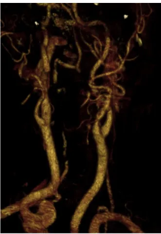 Fig. 4. Postoperative first-year control computerized to- to-mography angiography.