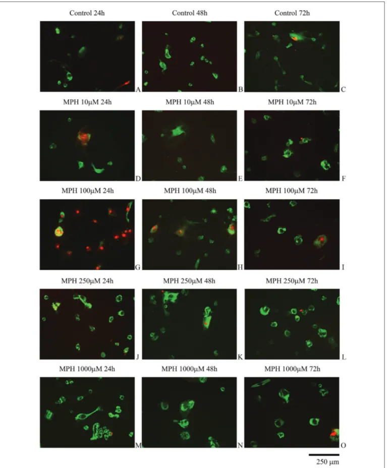Figure 2: Evaluation of intervertebral disc tissue cells by fluorescence microscopy. The cells in groups with high concentrations of  methylphenidate (MPH) and showing red nuclei and green cytoplasm are dead and have damaged membrane integrity.
