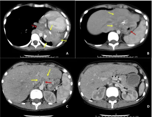 Fig. 1. Preoperative computed tomography sections  of  the  patient  (yellow  arrows:  tumor)