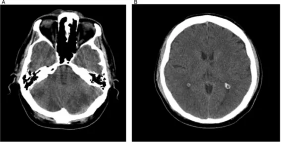 Figure 1 (A and B) Hypodense area concordant with infarct in bilateral cerebellar area distinct on the left side (A) and in thalamus on the left side in CT scan.