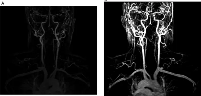 Figure 4 (A and B) Occlusion in right vertebral artery ’s intermediate and distal sections and artery distal of left vertebral in MR angiography.