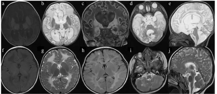 Fig. 1 Brain MRIs of infantile (patient 6, a –e) and early childhood (patient 10, f –j)