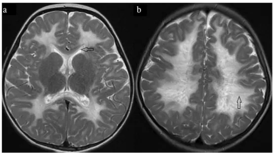 Fig. 3 Axial FLAIR images of different patients (9 and 3) with VWM. a There are confluent parietal subcortical areas of hyperintensity (star) with periventricular cystic