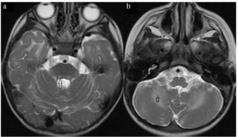 Fig. 4 Axial T2-weighted images of the patient 2. a There are bilateral pontine tegmental hyperintense lesions (arrow)