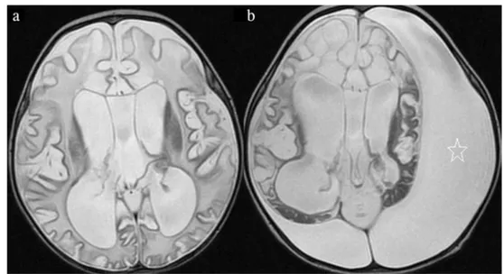 Fig. 6 Axial T2-weighted images(a, b) of the patient 6. The first brain MRI at the age of 8 months shows cystic degeneration (cerebrospinal fluid –like signal intensity) that causes progressive rarefaction and complete loss of nearly whole cerebral white m