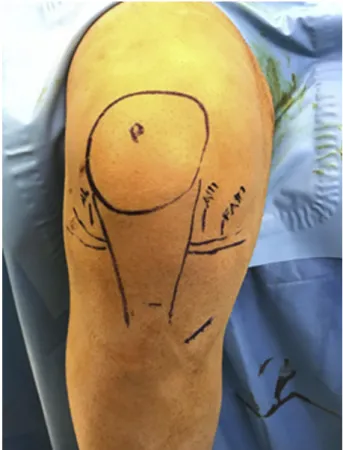 Fig 3. The elevation of the sartorius fascia.
