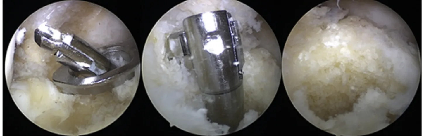 Fig 6. (Left) The introduction of Flip-Cutter into the joint through the tibial insertion of the ACL