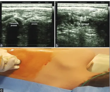 Figure 1: (a) Sonographic anatomy of the block (b) Needle direction and  spread of local anaesthetic