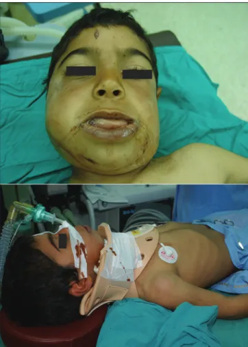 Figure 1: (Above) Preoperative view of the patient (below) operational  positioning of the patient