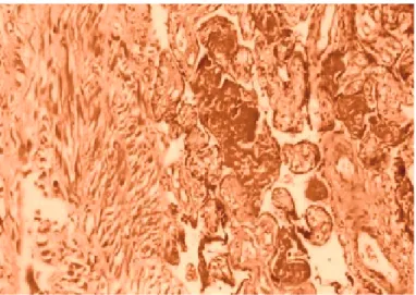 Figure 1. Pathology of placenta. Villi adhere directly to the my- my-ometrium without intervening decidua (HEx200)