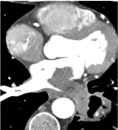 Figure 2. Axial contrast-enhanced CT shows a cavitary mass (M)  involving the left lower lobe and extending into the left atrium (LA)  through the left inferior pulmonary vein (LIPV)