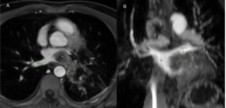 Figure 4. Axial BTFE (balanced turbo field echo) images during systole  (4a)  and  diastole  (4b)  reveals  a  mass  (M)  in  the  left  atrium  (LA)  protruding towards the mitral valve (MV)