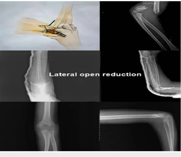 FIGURE 3: Lateral Open Reduction