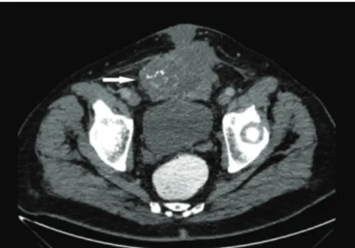 Figure 1: Cross-section contrast-enhanced computed tomography (CECT). There is a heterogeneous lesion (arrow) filling the bladder, extending to the anterior, and containing punctate amorphous calcifications.