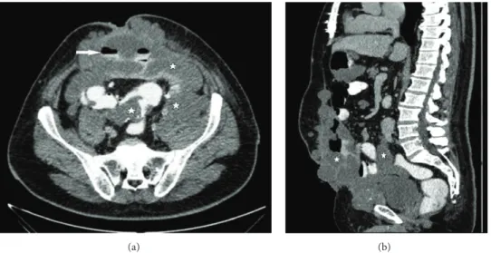 Figure 2: Cross-section (a) and sagittal (b) multiplanar reconstruction from CECT. These images demonstrate that the tumor creates air-fluid levels (arrow) by wrapping segments of intestine (stars) and extends from the anterior of the bladder to the anteri