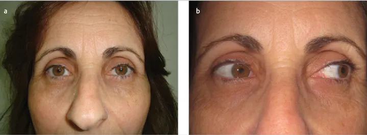 Figure 3. a,b. Clinical examination showing resolution of exotropia after BTA injection (a)