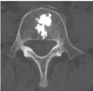 Figure 1. Axial plan CT scan. 3 ml polymethylmethacrylate  reached up to middle and anterior 1/3 vertebrae.