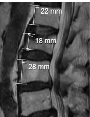 Figure 3. 2nd Lumbar vertebrae with 28% height loss.