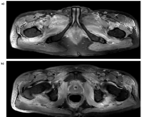 Figure 1 . a) Entrapment of obturator channel; b) Oedema in sciatic nerve