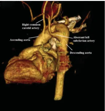 Fig. 2 3D computed tomography angiography image. Right aortic arch with aberrant left subclavian artery
