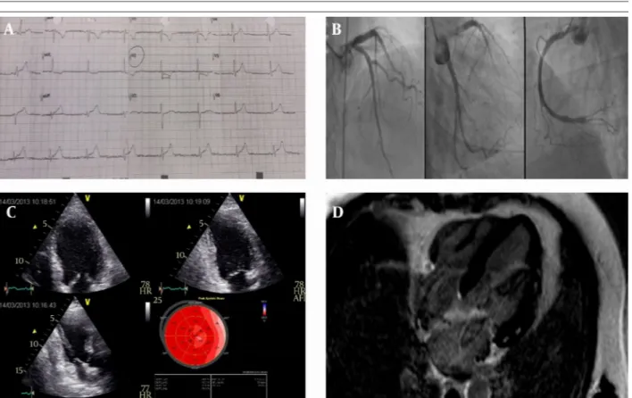 Figure 1. A, ECG of the patient showing marked ST segment elevations; B, coronary angiographic snapshots showing that the patient does not have signifi- signifi-cant coronary disease; C, ‘bull’s eye’ report of the longitudinal strain analysis showing heter