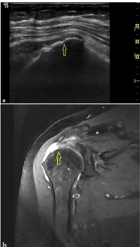 Şekil 2: Ultrasonografi imajında(a) suprapina- suprapina-tus tendon distal kesim artiküler yüzde parsiyel  yırtık ile uyumlu düzensizlik(ok), Koronal plan  PD TSE FS MR imajda (b) supraspinatus  tendonu distal artiküler yüzde parsiyel  yır-tık(ok), subdelt