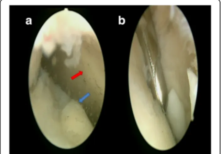 Fig. 1 a First view of the MTP joint by the 30° scope. Blue arrow is the metatarsal head