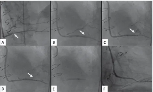 Figure 1.  (A) Angiographic image demonstrating a critical stenosis of the right posterior descending artery at the anastomosis  point of the saphenous vein graft