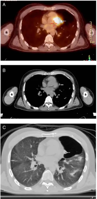 Figure 1 Axial PET-CT image (A) revealing a hypermetabolic subpleural nodule in the left upper lobe lingular segment
