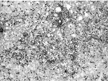 Figure 2. Adenocarcinoma. Glandular cells with large polarized  nuclei,  prominent  nucleoli  and  lacy  cytoplasm  (Papanicolaou 