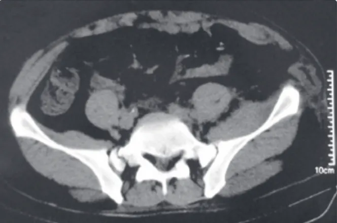 Şekil 1.  Bilgisayarlı batın tomografisinde sigmoid kolonun  bir segmentinin abdominal duvarın  muskuloapo-nevrotik katmanlarını geçerek cilt altına doğru  fı-tıklaşması.