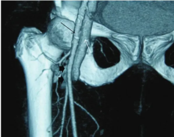 Figure 2: Two discrete arteriovenous fistulas are exposed; the first one (white arrow head on the left side) is between deep femoral artery (black arrow) and femoral vein (white arrow), and the other one (white arrow head on the right side) is between supe