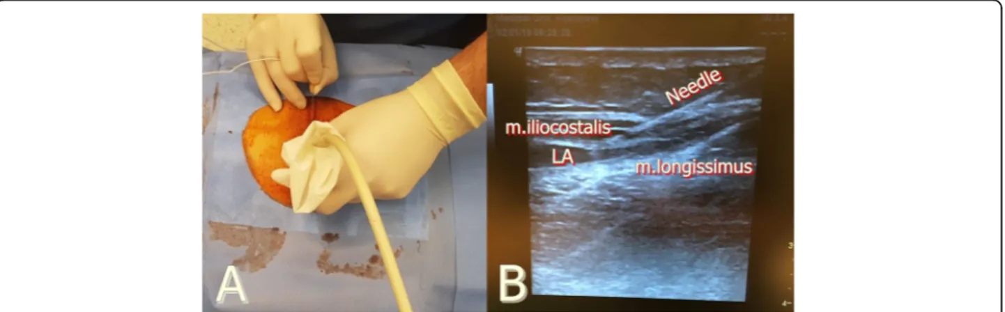 Fig. 2 a Ultrasound and patient setup for block preparation. b Sonographic anatomy and spread of local anesthetic