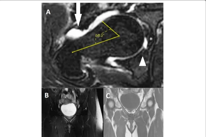 Fig. 2 Forty-five-year-old female with chronic hip pain and diagnosed femoroacetabular impingement