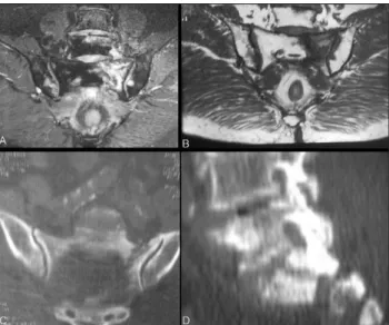 Figure 1: Preoperative radiological images of case 1. (A,B): T2- T2-and T1-weighted coronal views of the sacral spine demonstrate left sacral fracture and accompanying medullary edema
