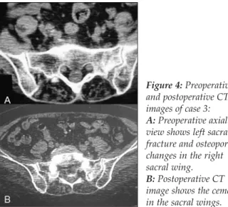Figure 4: Preoperative and postoperative CT images of case 3: