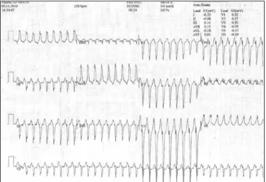 Figure 2. The cryoablation location for the Mahaim pathway is shown  in anterio-posterior view in this Figure
