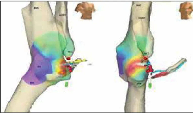 Figure 2. Local atrial activity preceded onset of the P wave by 53 msec