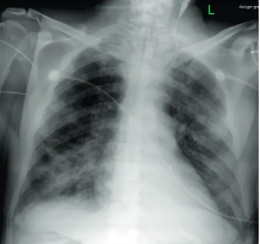 Figure 2: Chest roentgenogram of the patient after weaning oﬀ the ECMO.