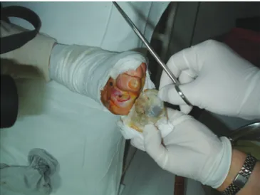 Şekil 1: Paket içinde steril larva uygulanmış hastadan paketin çıkartılması ve  kontrolü