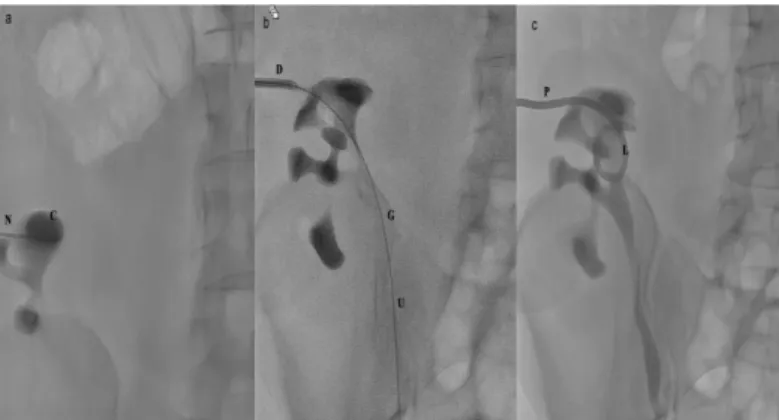 Figure 1. Radiographs show the basic technique of percutaneous  nephrostomy. (a) With the patient in the prone position, a 21G Chiba  needle (N) is passed into the upper pole calyx (C)