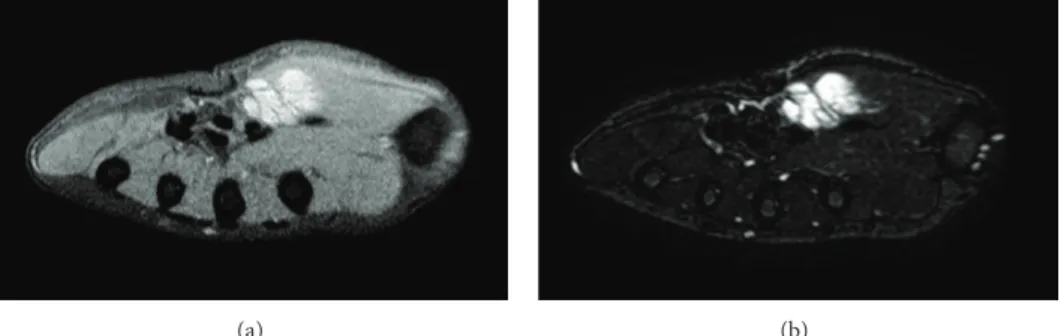 Figure 1: (a) Low signal intensity in T1A. (b) High signal intensity in T2A.